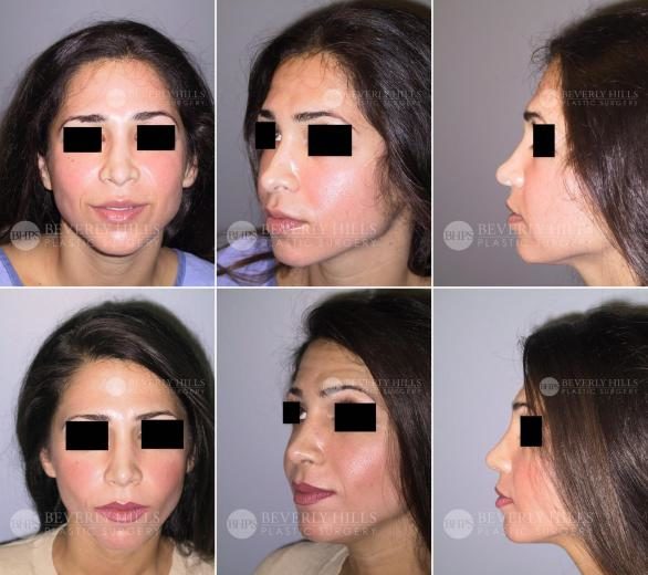 Before / After Image