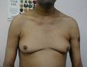 Gynecomastia Surgery Helps Young Boys