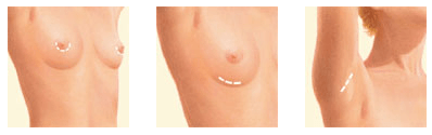 Breast Augmentation Beverly Hills