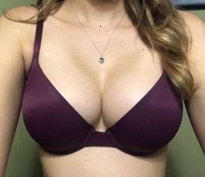 Gummy Bear Breast Implants - Dr. Kim Plastic Surgery
