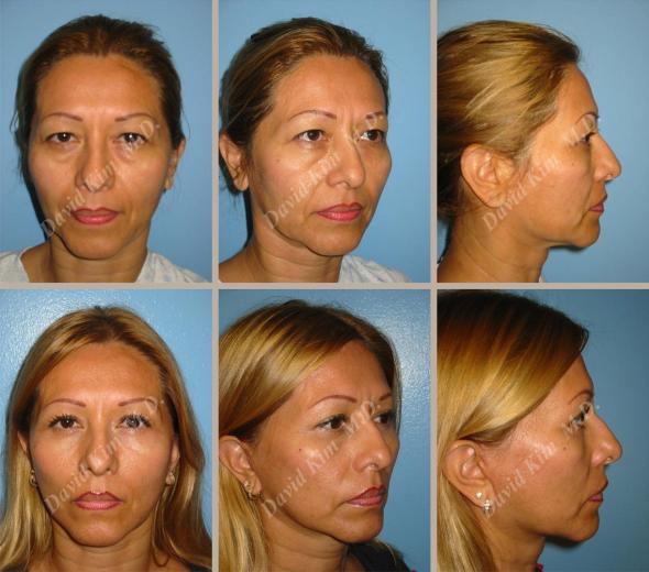 3 Beverly Hills Plastic Surgery