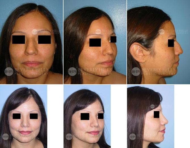 9 Beverly Hills Plastic Surgery