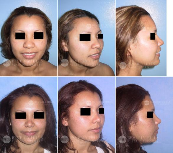 29 Beverly Hills Plastic Surgery