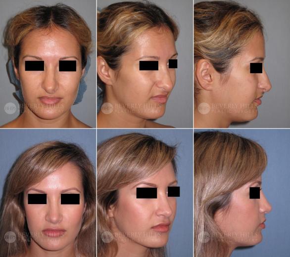 31 Beverly Hills Plastic Surgery