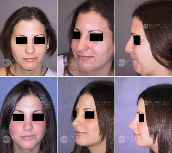39 Beverly Hills Plastic Surgery