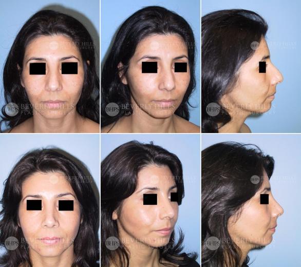 45 Beverly Hills Plastic Surgery