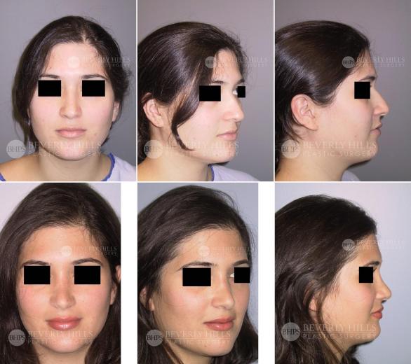 55 Beverly Hills Plastic Surgery