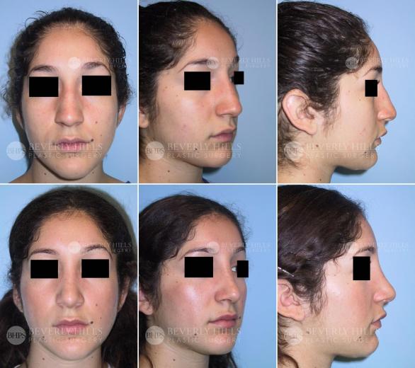 58 Beverly Hills Plastic Surgery
