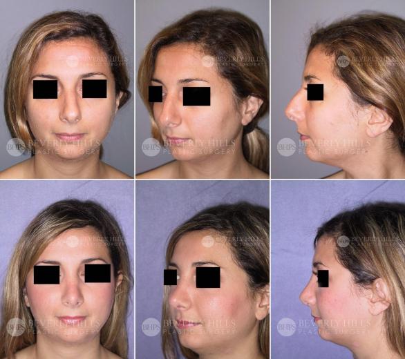 68 Beverly Hills Plastic Surgery