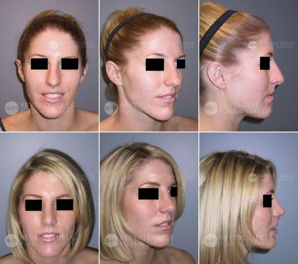 74 Beverly Hills Plastic Surgery