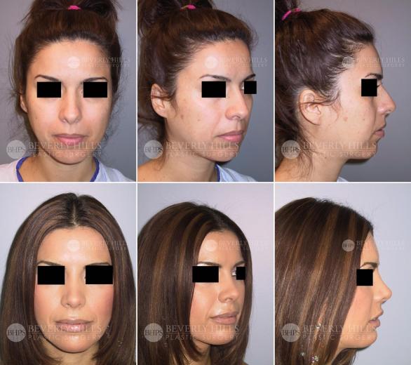 90 Beverly Hills Plastic Surgery