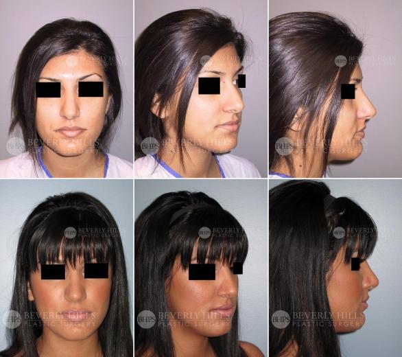 94 Beverly Hills Plastic Surgery