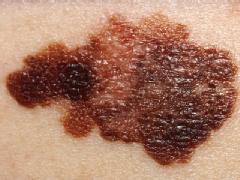 DNA treatment effective against melanoma