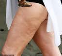 Cellulite truth, don’t believe the hype