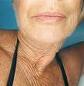 Plastic surgery blog: The painless facelift&#8230; Does it deliver?