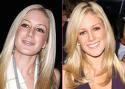 Heidi Montag Blames Her Cellulite on Her Liposuction Procedure