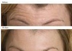 Why Women Use Botox