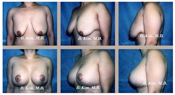 Breast Lift Plastic Surgery Before and After Photos