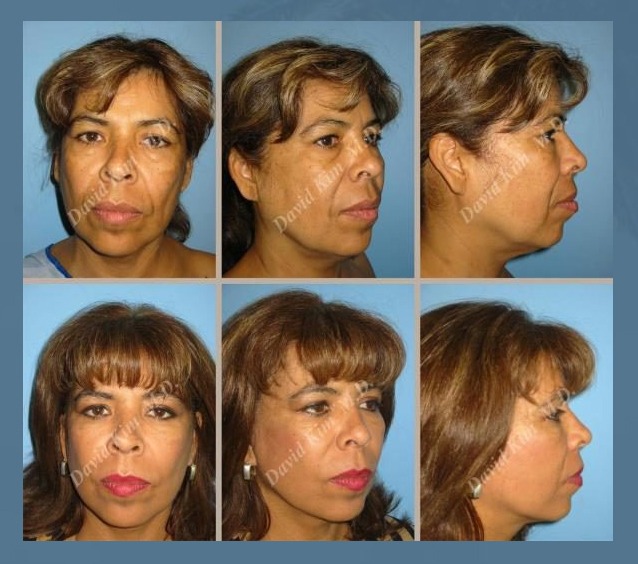 Facelift Surgery Before and After Photos
