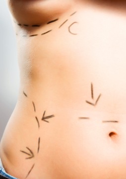 Lymphedema Post Plastic Surgery Diagnosis &#038; Treatment