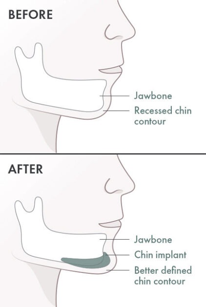 Chin Augmentation Before And After Photos