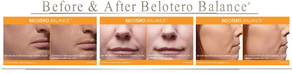 How Much Does Belotero Balance Dermal Filler Cost?