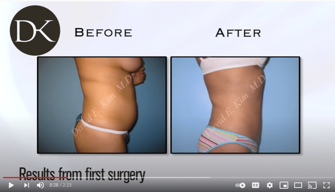 Tummy Tuck Revision Los Angeles & Beverly Hills