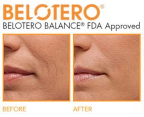 Belotero Balance Dermal Filler