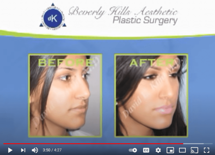 Rhinoplasty
