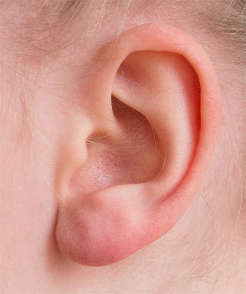 Ear Surgery (Otoplasty) Before And After Photos