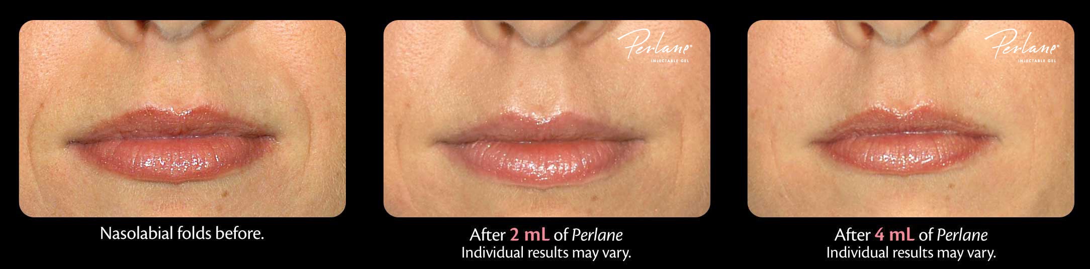 Perlane Dermal Filler Before And After Photos