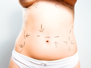 Is A Tummy Tuck or Lipo Better?