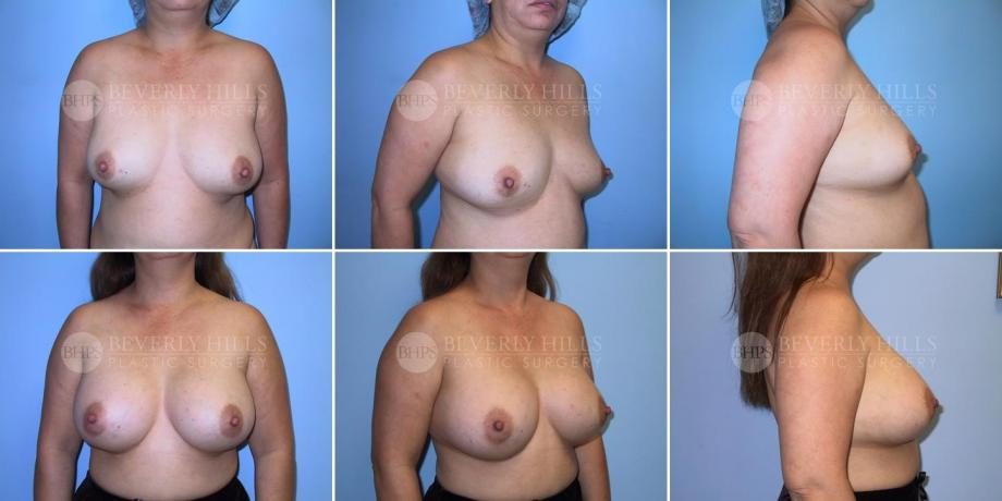 Image of patient post surgery