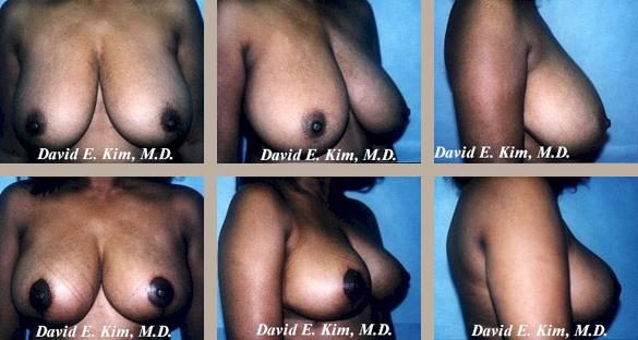 Breast Reduction Plastic Surgery Before And After Photos