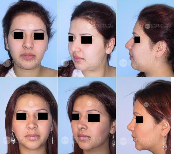 Image of patient post surgery