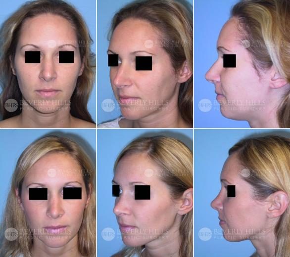 Image of patient post surgery