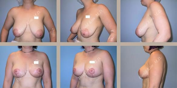 Image of patient post surgery