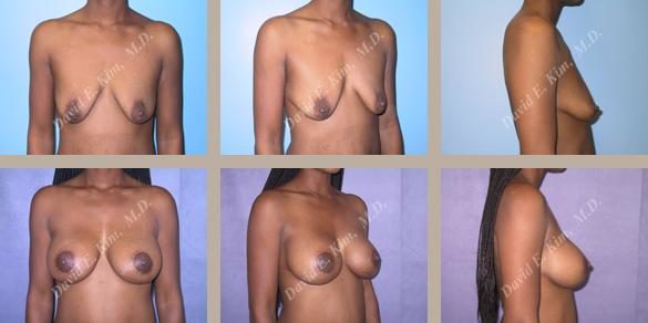Image of patient post surgery