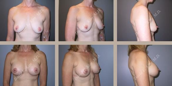Image of patient post surgery