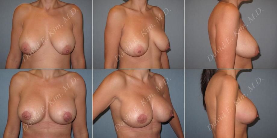 Image of patient post surgery