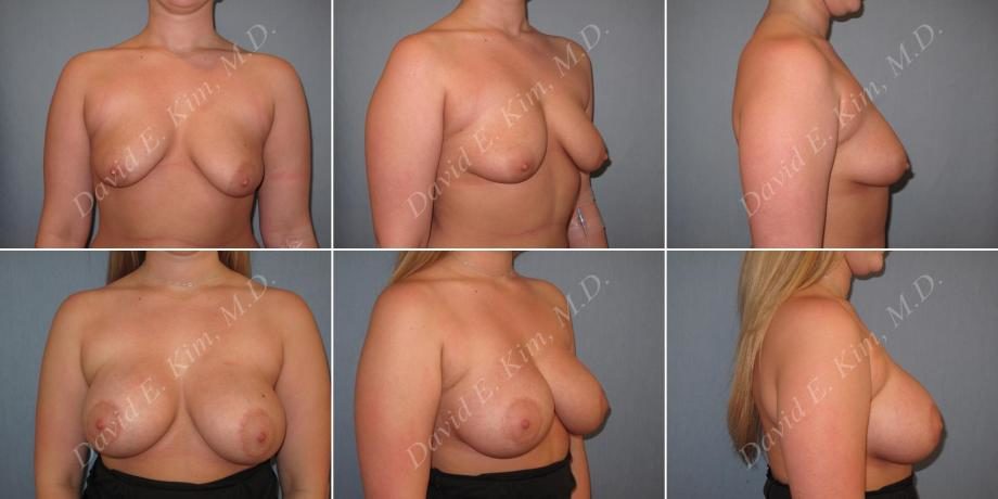 Image of patient post surgery