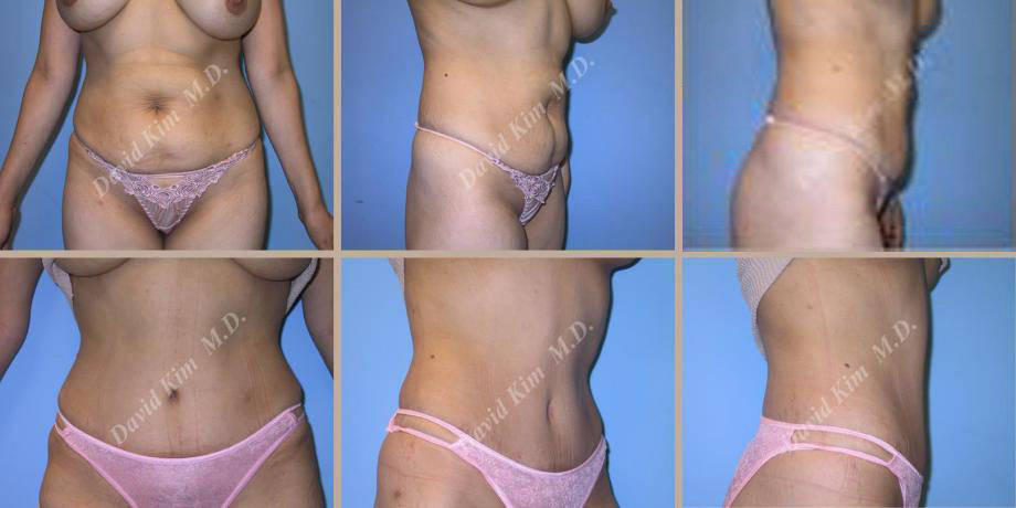 Image of patient post surgery