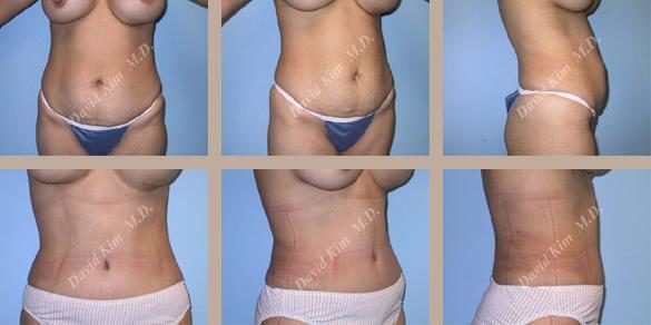 Image of patient post surgery