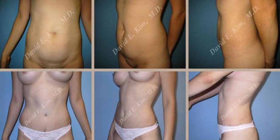Image of patient post surgery