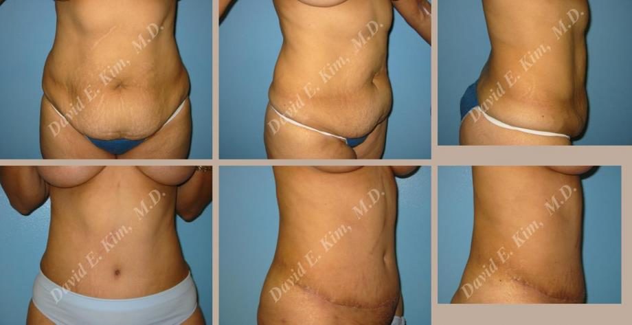 Image of patient post surgery