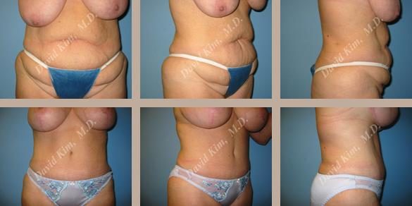 Image of patient post surgery
