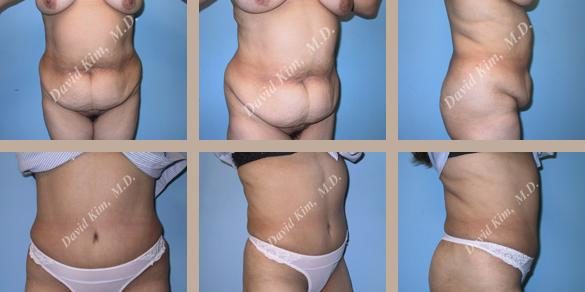Image of patient post surgery