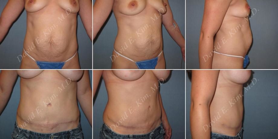 Image of patient post surgery