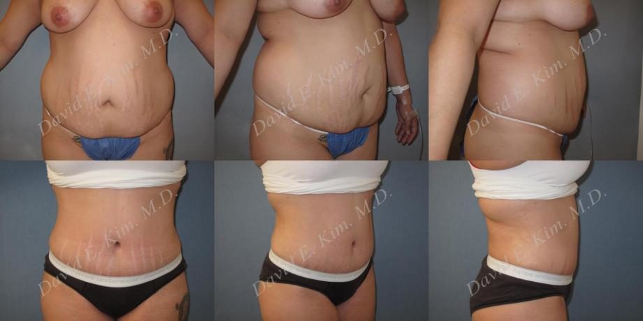 Image of patient post surgery