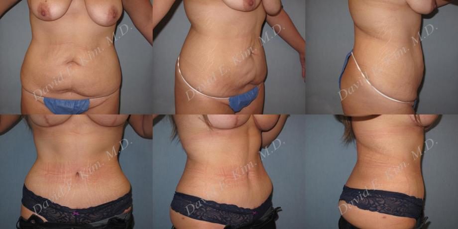 Image of patient post surgery